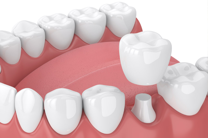 Dental Crowns in Rockville