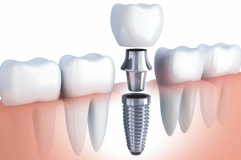 Implants Dentist in Rockville