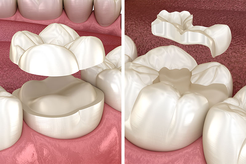 Dental Inlays and Onlays in Rockville