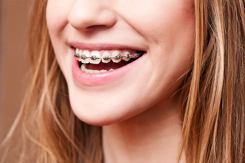 Orthodontics in Rockville