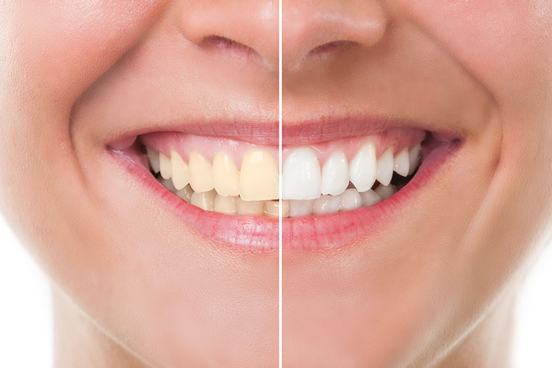 Teeth Whitening in Rockville