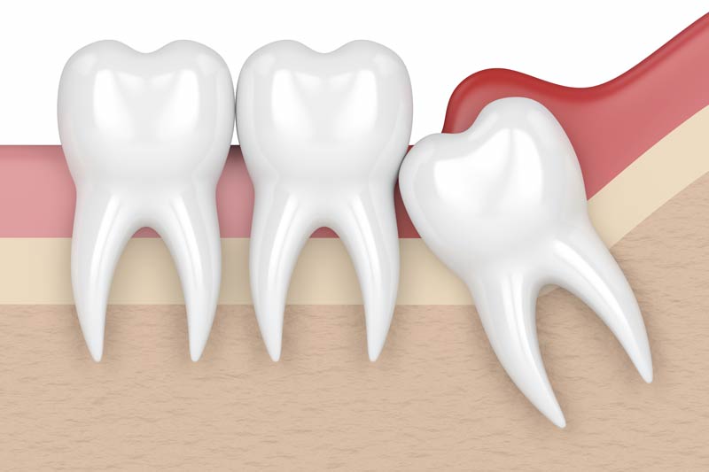 Wisdom Tooth Removal in Rockville